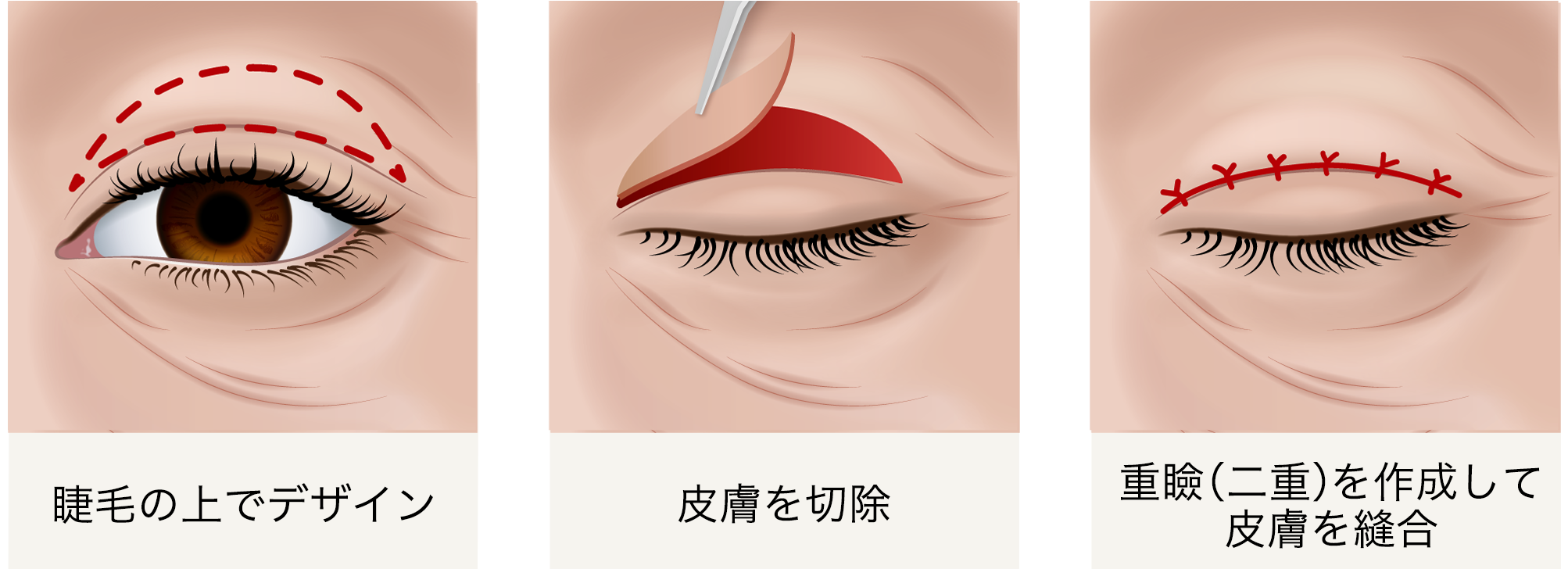 眼瞼皮膚弛緩症がんけんひふしかんしょう - 【公式】目黒まぶたのクリニック|目黒駅徒歩4分・保険診療|眼瞼下垂・逆さまつ毛