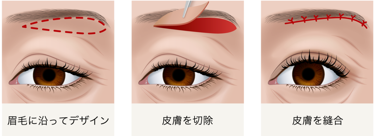 眼瞼皮膚弛緩症がんけんひふしかんしょう - 【公式】目黒まぶたのクリニック｜目黒駅徒歩4分・保険診療｜眼瞼下垂・逆さまつ毛