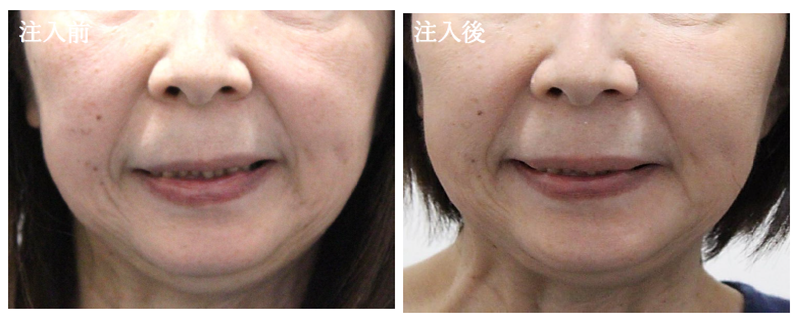 口角の左右差に対する美容用ヒアルロン酸注入治療