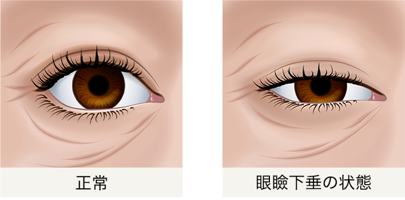 眼瞼下垂の目の状態