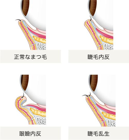 内反症