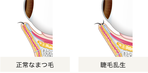 睫毛乱生症