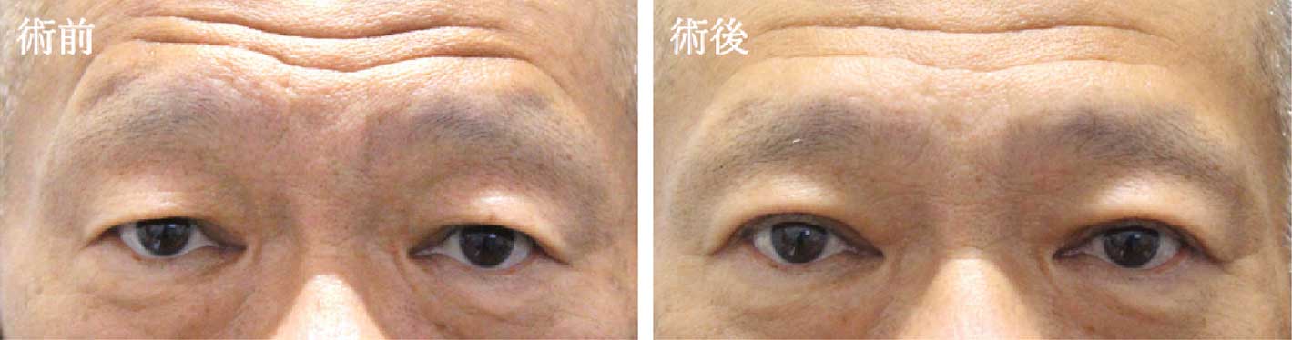 両眼 皮膚切除術（重瞼作成）の術前術後写真