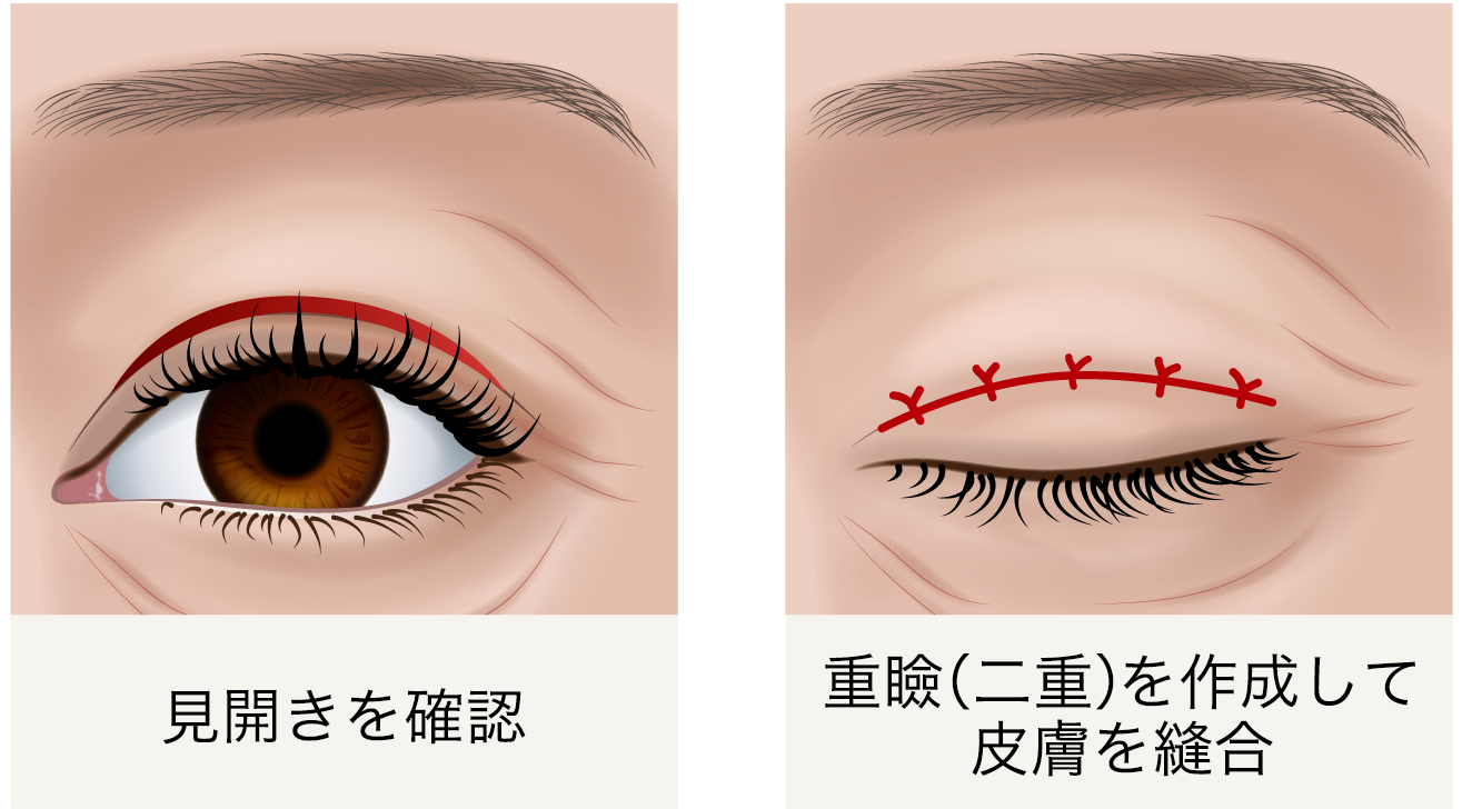 眼瞼下垂 挙筋前転法